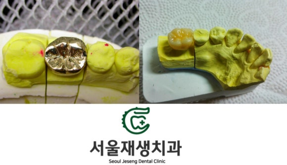 이갈이, 이악물기로 치아가 깨졌어요. 어떻게 치료하나요? (크라운치료 장단점, 레진치료 장단점, 신촌치과,서울재생치과,치아파절,어금니치료) 관련 이미지 4