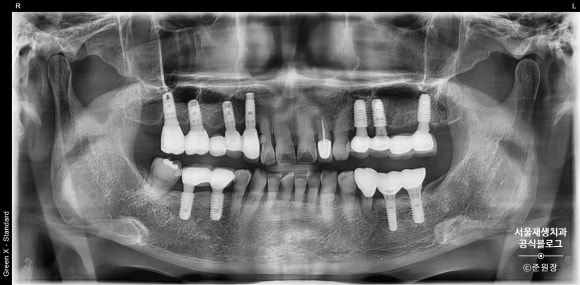 [턱관절] 임플란트 맞은 편 치아가 아파요! (외상성교합, 강한 교합력, 보톡스 치료,턱관절물리치료, 치과 보험진료) 관련 이미지 2