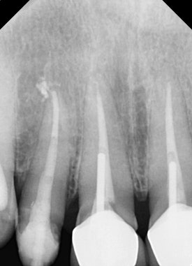 [치아살리기] 크라운 씌운 치아가 부러졌어요. 교정적정출술을 통해 내 치아 끝까지 써보기 관련 이미지 7