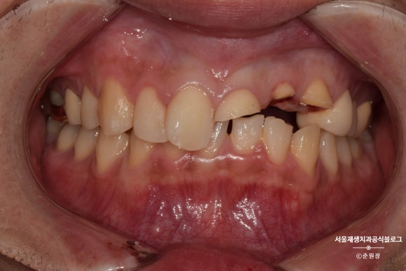 [치아외상] 부러진 앞니, 발치가 답인가요? (사고로 부러진 치아, 외과적정출술로 살리기) 관련 이미지 2