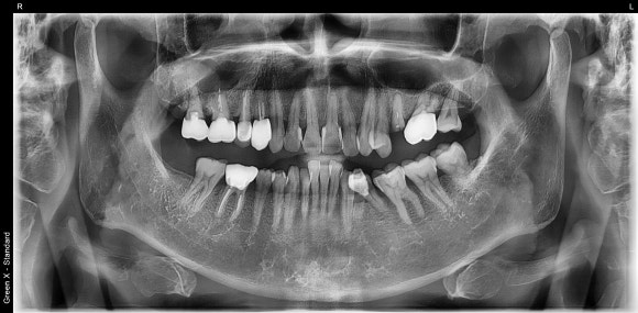 부러진 치아를 살려서 쓰는 법 (잇몸성형과 포스트식립) 관련 이미지 3