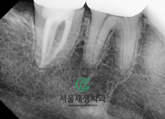 재신경치료 2년 후, 다시 찾아오신 반가운 얼굴^^ (서울재생치과 준원장) 관련 이미지 5
