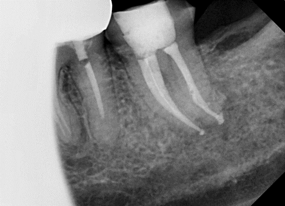 [신경치료] 아래 어금니를 신경치료 할 때 치료할 때 알아야 할 것 (C형근관,고난이도치료) 관련 이미지 11