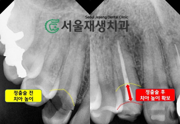 [치아정출술] 충치가 뿌리까지 진행되서 발치해야 한대요...뿌리 깊은 충치도 살려내기 (서울재생치과) 관련 이미지 8