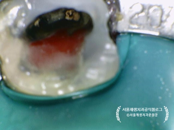 [재신경치료] 예전에 신경치료 받은 치아가 갑자기 붓고 아파요! (현미경을 통해 정확하고 섬세하게 재신경치료 하기) 관련 이미지 28