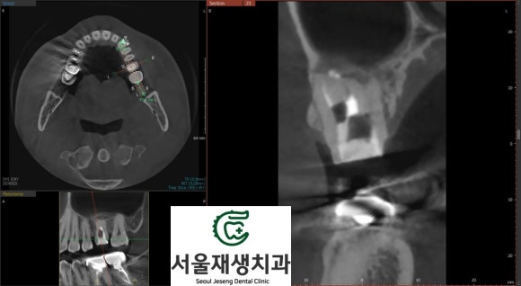 [재신경치료] 재신경치료까지 했는데 계속 아파요..미세 현미경을 이용한 세번째 신경치료! (서울재생치과) 관련 이미지 8