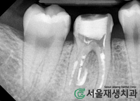 [재신경치료] 신경치료 받은 치아가 붓고 아파요! 현미경과 CT의 도움으로 다시 한 번 꼼꼼하게~ 관련 이미지 15