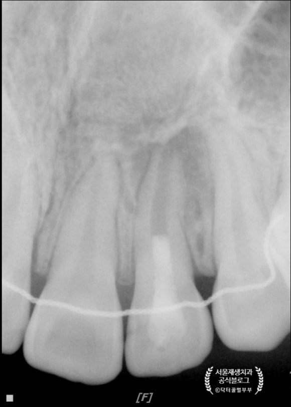 [재생근관치료] 이가 난지 얼마 안 됐는데 신경이 죽었대요...(소아 치아 외상, 치수 괴사, 미성숙 영구치, 신경재생술, REP, 치료기간, MTA 신경치료, 내원횟수) 관련 이미지 16