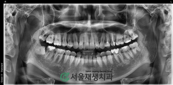 [재신경치료] 다른 치과에서 빼라고 했는데...혹시 살릴 수는 없을까요? (현미경 신경치료, 서울재생치과) 관련 이미지 3