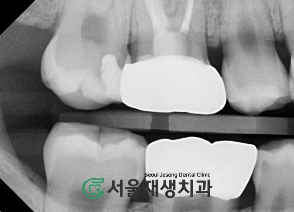 [MTA충치치료] 충치가 클 때.. 신경치료 안하고 치료하는 법 (치수복조술, 신촌 서울재생치과) 관련 이미지 13