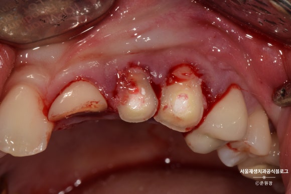 [치아외상] 부러진 앞니, 발치가 답인가요? (사고로 부러진 치아, 외과적정출술로 살리기) 관련 이미지 13