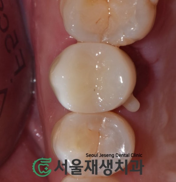 [치아파절] 밥 먹다가 이가 반으로 쪼개졌어요....이런 치아도 살릴 수 있나요? (깨진 치아 치료하기, 신촌 서울재생치과) 관련 이미지 9
