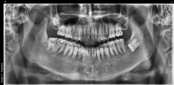 [치아살리기] 뿌리만 남은 치아의 치료 관련 이미지 3