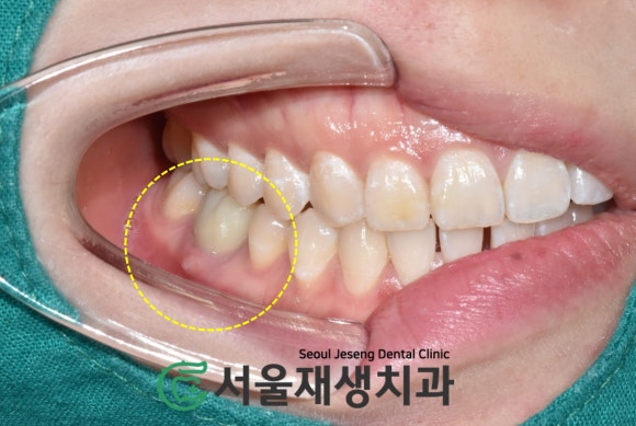 [재신경치료] 신경치료 받은 치아가 붓고 아파요! 현미경과 CT의 도움으로 다시 한 번 꼼꼼하게~ 관련 이미지 3