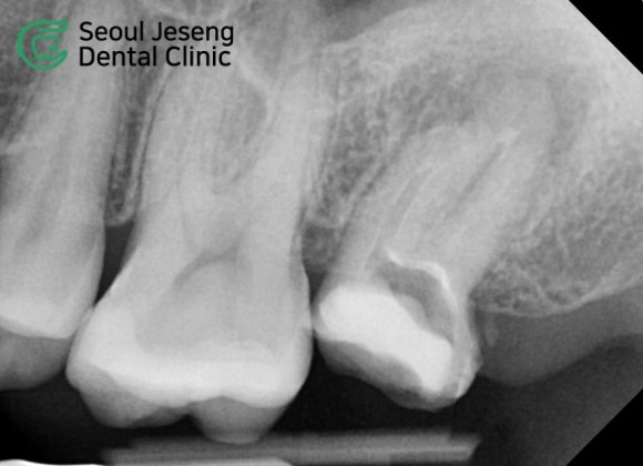 [재신경치료] 타치과에서 재신경치료 하는 중인데 발치를 하자고 했어요... (서울재생치과 현미경 신경치료) 관련 이미지 4