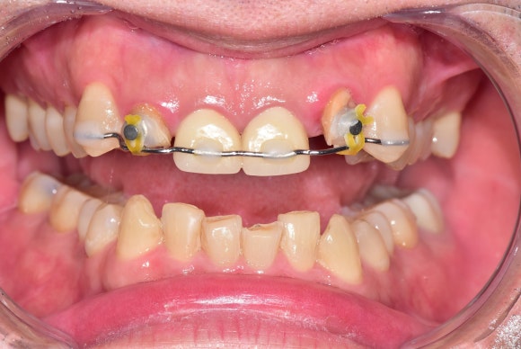 [치아살리기] 크라운 씌운 치아가 부러졌어요. 교정적정출술을 통해 내 치아 끝까지 써보기 관련 이미지 6