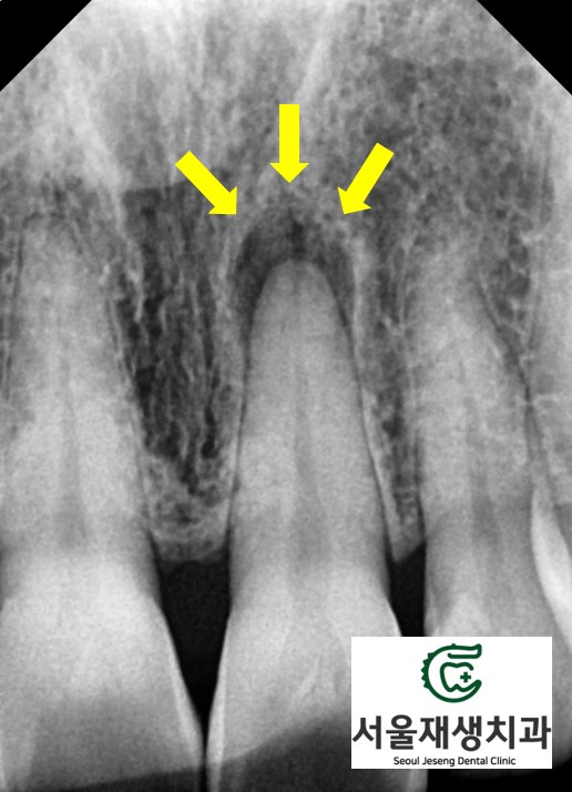 [치아미백] 예전에 다친 치아가 최근에 변색됐어요. 어떻게 해결하나요? (서울재생치과) 관련 이미지 4