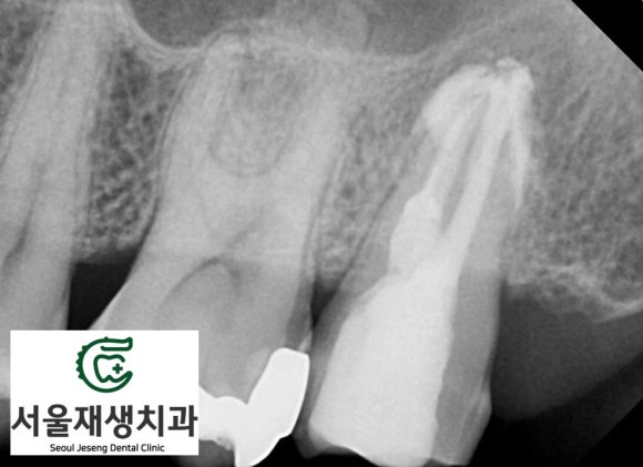[재신경치료] 40대 남성, 윗 어금니 신경치료 후 상악동까지 염증이 전파된 사례 (서울재생치과 미세현미경치료) 관련 이미지 10