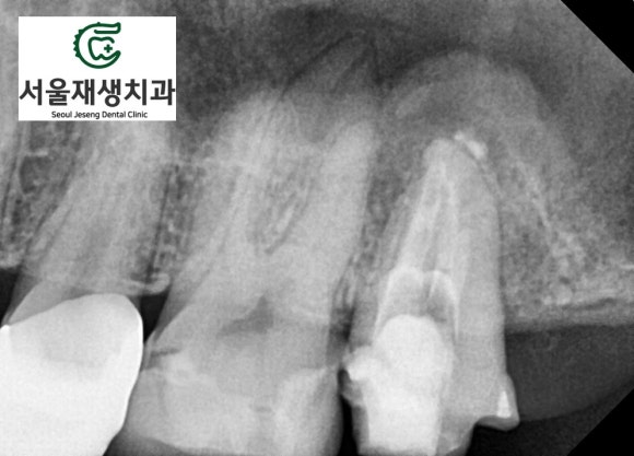[재신경치료] 예전에 신경치료 한 치아가 갑자기 붓고 아파요! (현미경 신경치료, 서울재생치과) 관련 이미지 10