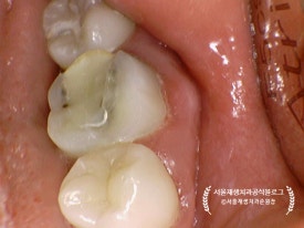 [재신경치료] 예전에 신경치료 받은 치아가 갑자기 붓고 아파요! (현미경을 통해 정확하고 섬세하게 재신경치료 하기) 관련 이미지 13