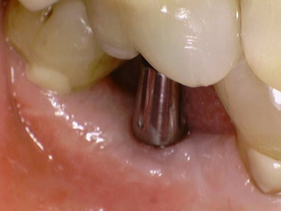 [임플란트] 이가 빠진지 오래되서 옆 치아들이 쓰러졌어요. 임플란트 가능할까요? 네, 가능합니다.1mm의 정교함으로! 관련 이미지 7