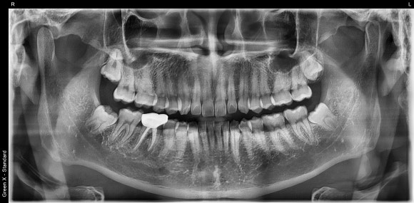 [재신경치료] 6개월 전에 신경치료한 치아에서 고름이 나와요. 관련 이미지 3