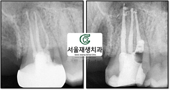 [재신경치료] 엑스레이를 찍었더니 치아 뿌리 염증이 보인대요! (현미경 신경치료, 서울재생치과) 관련 이미지 8
