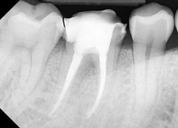 [재신경치료] 6개월 전에 신경치료한 치아에서 고름이 나와요. 관련 이미지 8