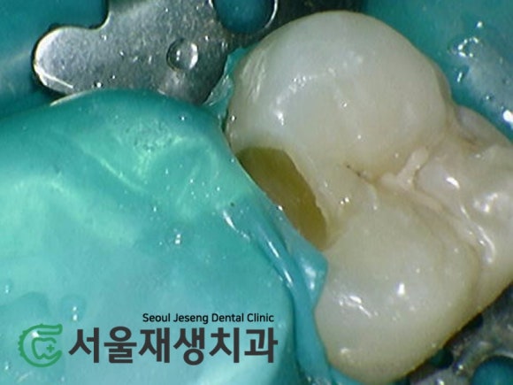 [MTA충치치료] 충치가 클 때.. 신경치료 안하고 치료하는 법 (치수복조술, 신촌 서울재생치과) 관련 이미지 10
