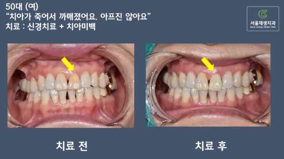 치아가 변색되면 무조건 크라운을 해야 하나요? (치아 미백, 실활치 미백, 신경치료 후 미백, 신촌치과추천,서울재생치과) 관련 이미지 10