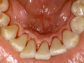 스케일링, 1년에 한 번만 보험이 되나요? 보험스케일링 수시로 받는 법 (건강보험적용 치과치료) 관련 이미지 3