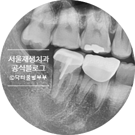 [재신경치료] 치아 뿌리 끝 염증이 너무 심하대요...발치만이 답일까요? 관련 이미지 3