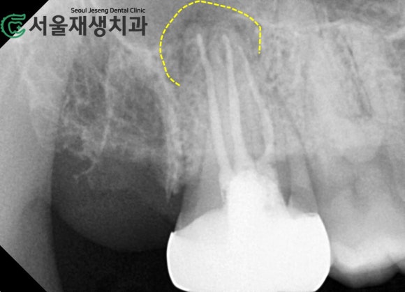 [재신경치료] 엑스레이를 찍었더니 치아 뿌리 염증이 보인대요! (현미경 신경치료, 서울재생치과) 관련 이미지 4