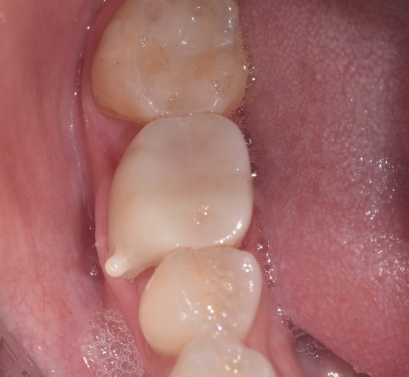 [신경치료] 예전에 크라운을 씌운 치아인데 갑자기 시려졌어요. 관련 이미지 6