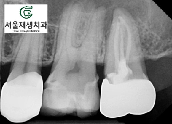 [재신경치료] 예전에 신경치료 한 치아가 갑자기 붓고 아파요! (현미경 신경치료, 서울재생치과) 관련 이미지 6