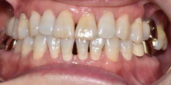 치아가 변색되면 무조건 크라운을 해야 하나요? (치아 미백, 실활치 미백, 신경치료 후 미백, 신촌치과추천,서울재생치과) 관련 이미지 6