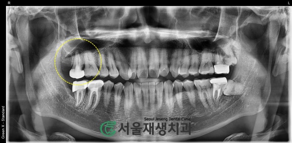 [재신경치료] 엑스레이를 찍었더니 치아 뿌리 염증이 보인대요! (현미경 신경치료, 서울재생치과) 관련 이미지 3