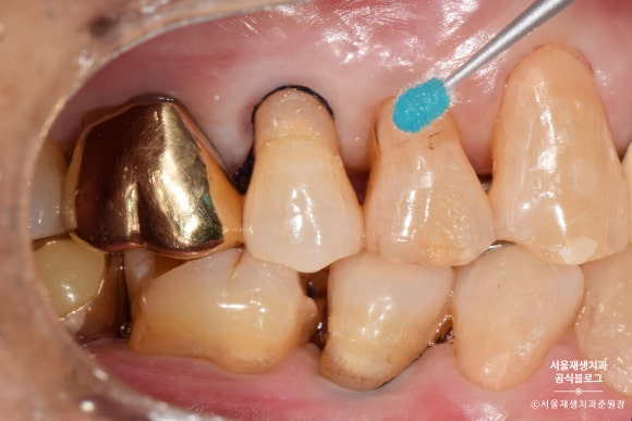 잇몸 패임, 무슨 재료로 때우나요? 레진과 글라스아이오노머(GI)로 치경부마모증 치료하기 (서울재생치과,신촌치과) 관련 이미지 22