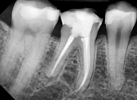 [신경치료] 예전에 크라운을 씌운 치아인데 갑자기 시려졌어요. 관련 이미지 5