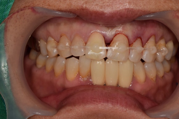 [치아외상] 넘어졌는데 이가 쏘옥 빠졌어요....! (안면부 외상, 치아 탈구, 치아 재식,서울재생치과) 관련 이미지 7