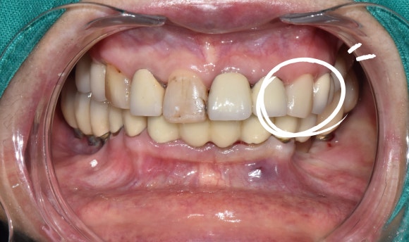 크라운 다음은 임플란트인가요...? (크라운 밑으로 생긴 충치, 크라운 다음엔 어떤 치료를...?, 자연치아 살리는 치과, 서울재생치과) 관련 이미지 10