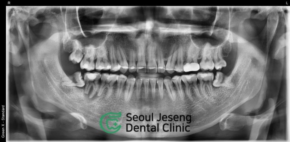 [고난이도 신경치료] 사랑니 때문에 뿌리가 흡수되어 버린 치아...살릴 수 있나요? 관련 이미지 2