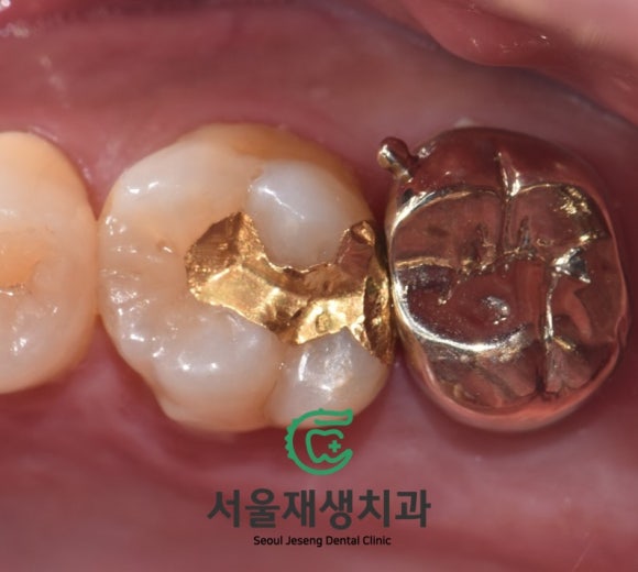 [재신경치료] 40대 남성, 윗 어금니 신경치료 후 상악동까지 염증이 전파된 사례 (서울재생치과 미세현미경치료) 관련 이미지 13