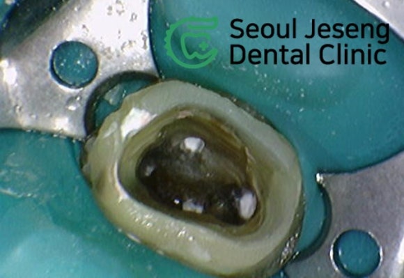 [재신경치료] 재신경치료까지 했는데 계속 아파요..미세 현미경을 이용한 세번째 신경치료! (서울재생치과) 관련 이미지 7