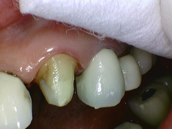 크라운 다음은 임플란트인가요...? (크라운 밑으로 생긴 충치, 크라운 다음엔 어떤 치료를...?, 자연치아 살리는 치과, 서울재생치과) 관련 이미지 7