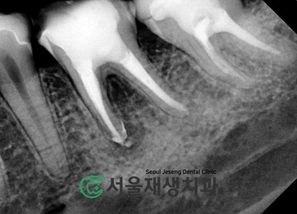 [재신경치료] 예전에 신경치료 받은 치아....치근단 절제술이나 발치를 해야 한다는데요?! (신촌 서울재생치과) 관련 이미지 12