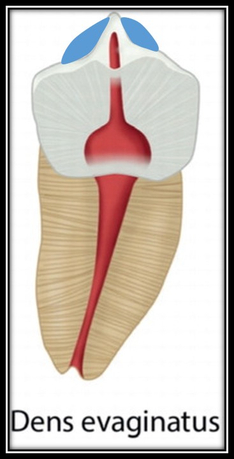 [치외치신경치료] 뿌리 끝 염증이 커서 발치해야된대요! 치아 머리에 볼~록! 알고보면 무서운 작은 혹 (서울재생치과) 관련 이미지 9