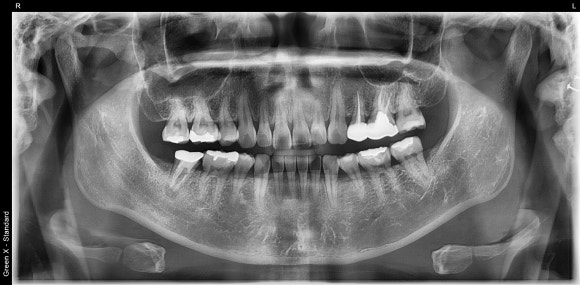 [재신경치료] 잇몸이 부었어요. 다니던 치과에서는 재신경치료 하거나 발치하라고 했어요. 관련 이미지 3