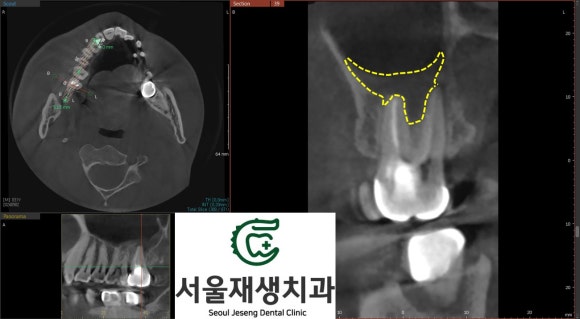 [재신경치료] 엑스레이를 찍었더니 치아 뿌리 염증이 보인대요! (현미경 신경치료, 서울재생치과) 관련 이미지 5