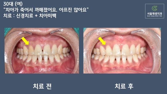 치아가 변색되면 무조건 크라운을 해야 하나요? (치아 미백, 실활치 미백, 신경치료 후 미백, 신촌치과추천,서울재생치과) 관련 이미지 16